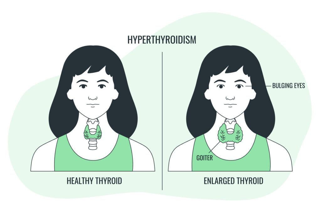 What can happen due to low iodine intake